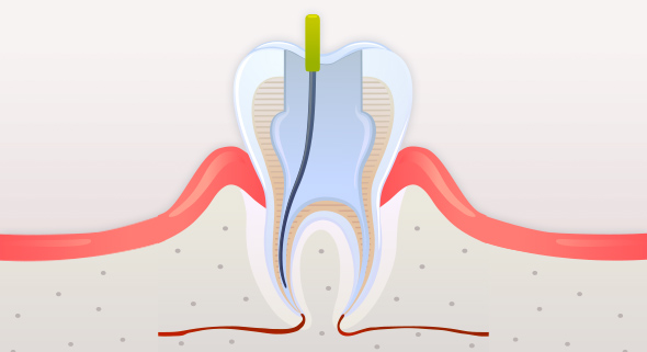 충치 및 신경조직 제거