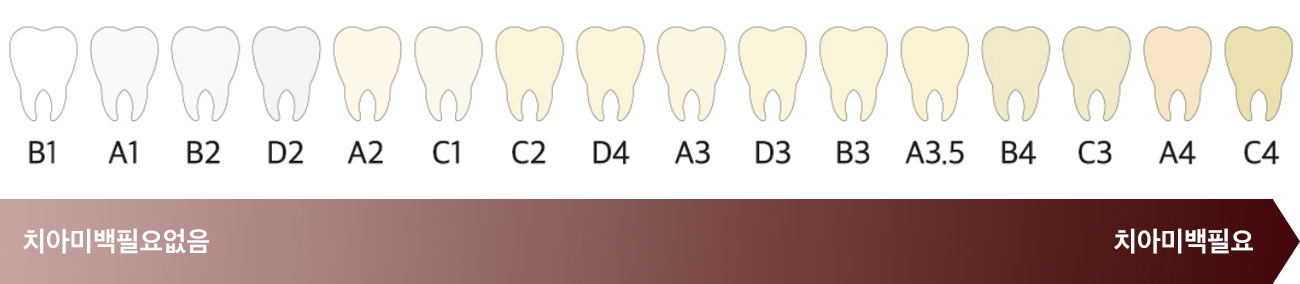 치아색상 자가진단법